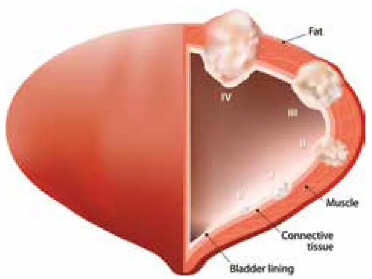 ccc bladder men cancer