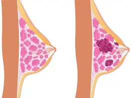 ccc breast cancer classification