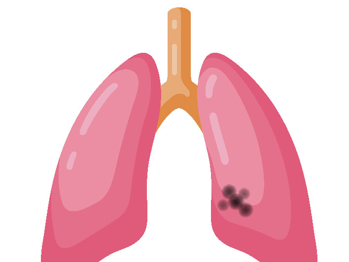 ccc lung cancer