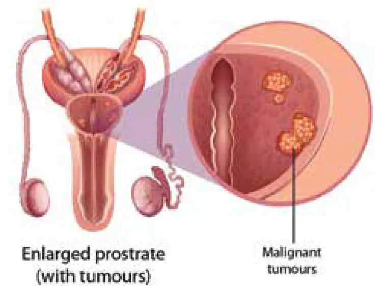 ccc prostate cancer