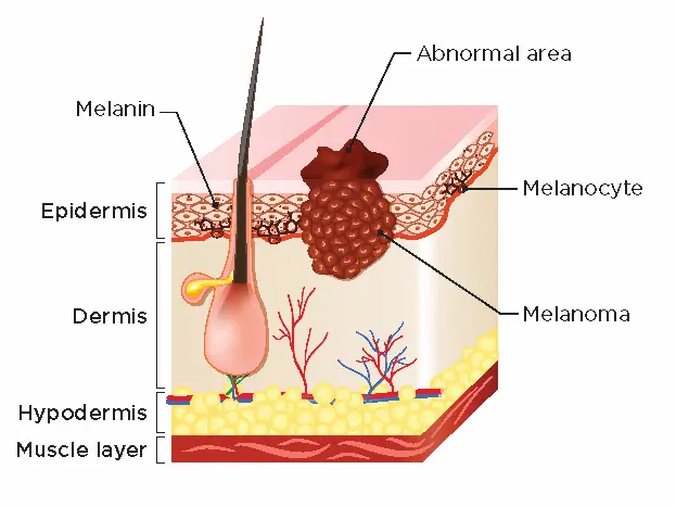 ccc skin cancer classification