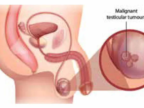 ccc testicualr cancer